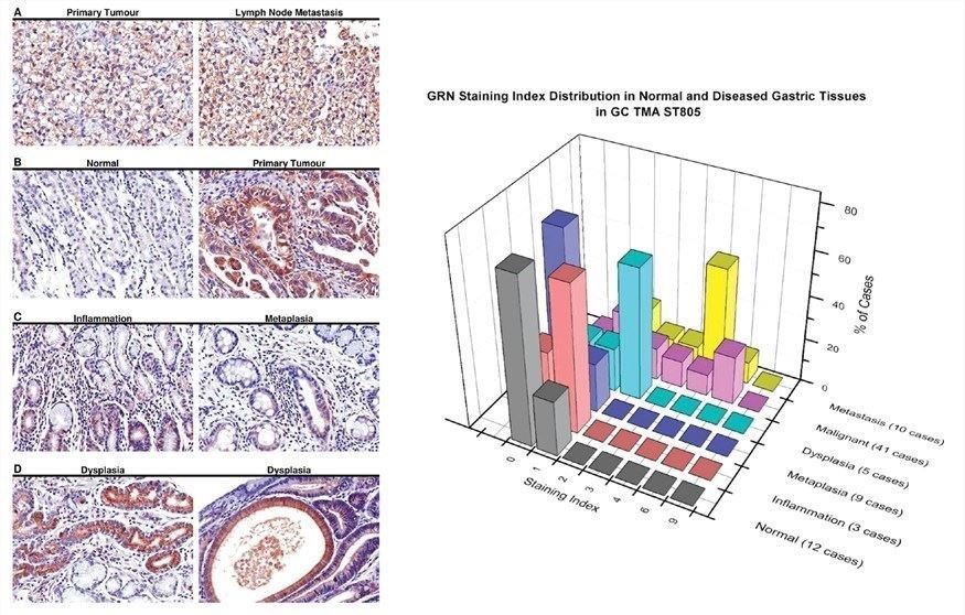 (Left) Overexpression of GRN was found in GC tissues and dysplastic gastric tissues by immunohistochemical staining on GC tissue microarrays. (Right) GRN staining index distribution in normal and diseased gastric tissues in GC tissue microarrays.